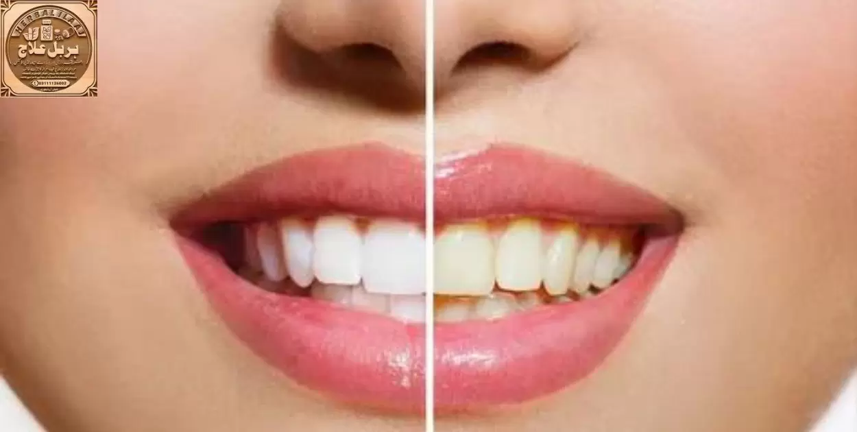 Is It Worth It To Save Money With Generic Teeth Whitening Strips?